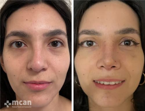 Nose job surgery - Before After