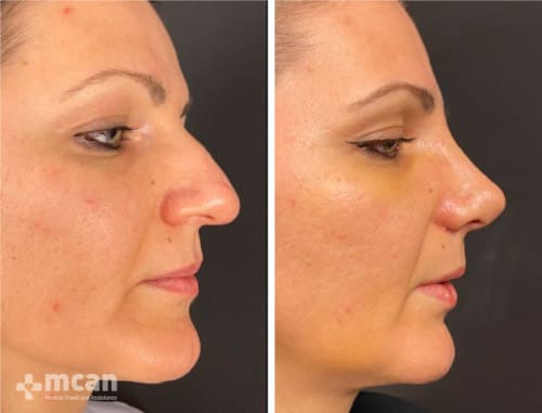 Astonishing Nose Job before-after