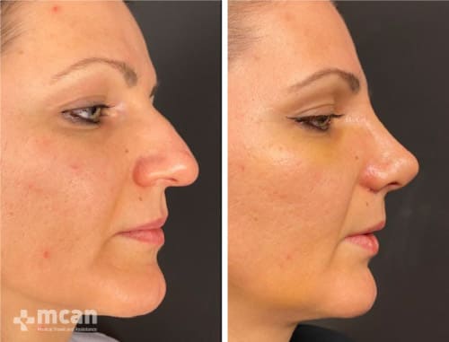 Rhinoplasty in Turkey