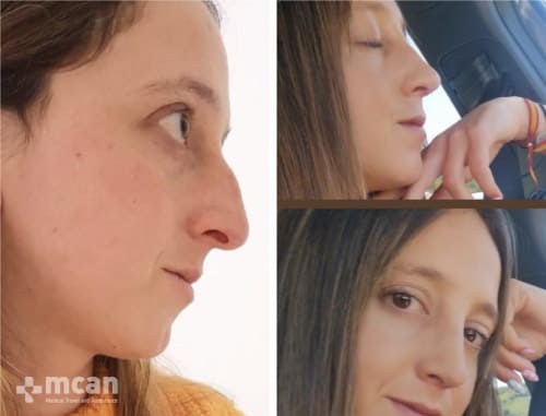 Remarkable results of nose job Turkey