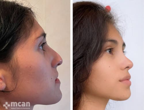 Best Rhinoplasty before-after