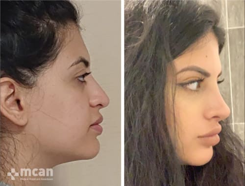 Nose Job Turkey before-after