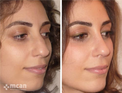 Nose job Turkey before and after