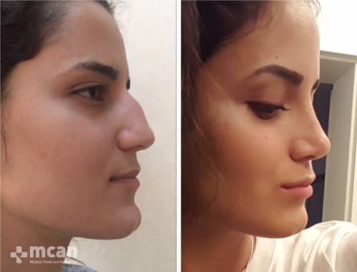 nose surgery side angel before after