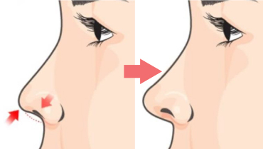 Rhinoplasty