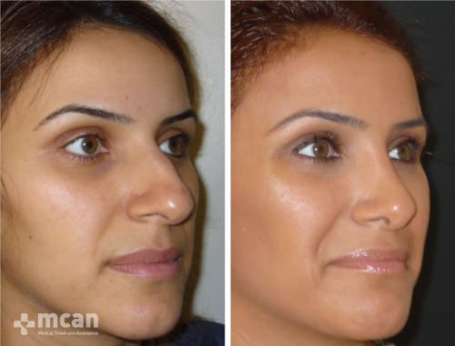 Rhinoplasty Turkey before and after