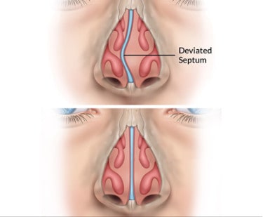 septoplasty