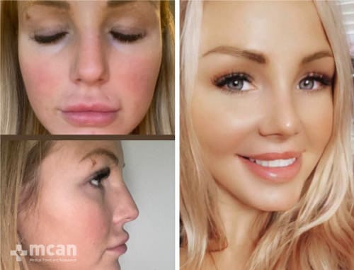 Nose job before and after