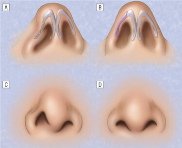 Post-Traumatic Rhinoplasty