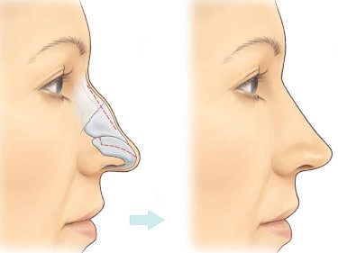 Refinement Rhinoplasty (Tip Plasty)