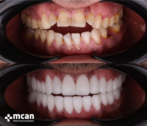 Dental crowns turkey before and after