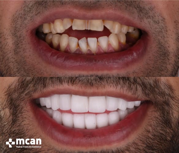 Antes y después de las coronas dentales 2