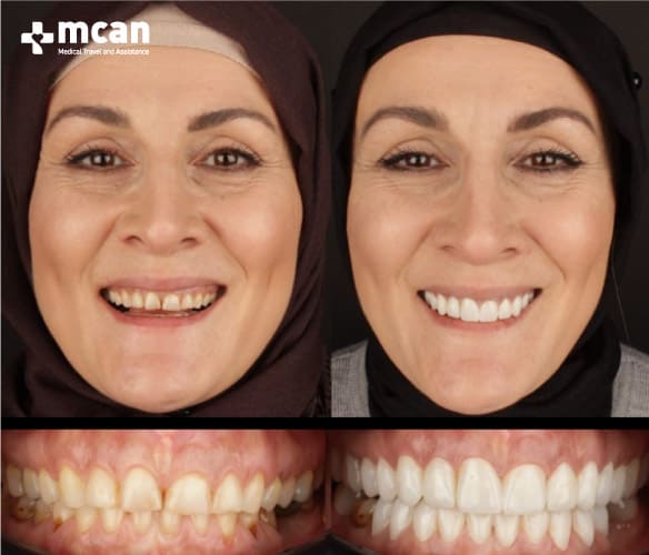 Antes y después del blanqueamiento dental 11