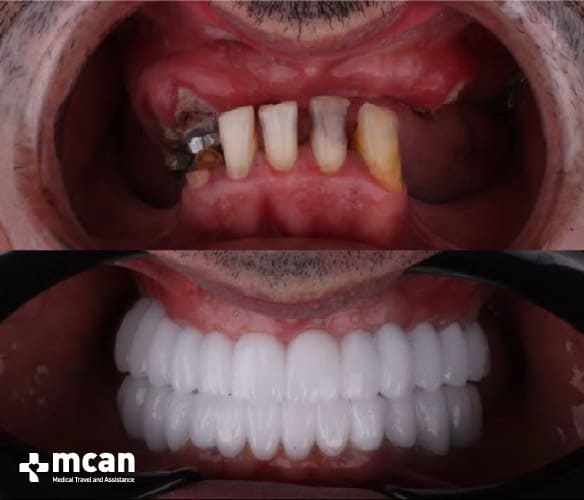 Antes y después de las coronas dentales 3
