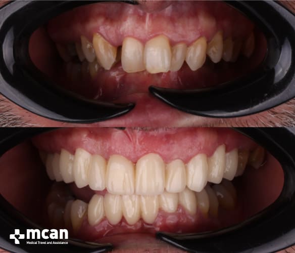 Antes y después de las coronas dentales 4