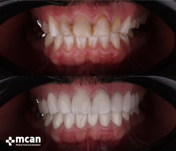 Antes y después de las coronas dentales 6