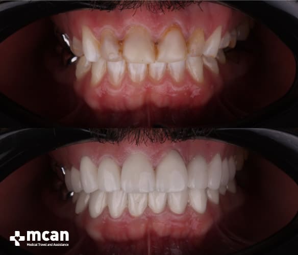 After dental crowns Turkey