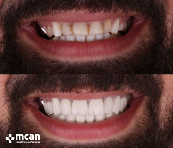 Antes y después de las coronas dentales 7