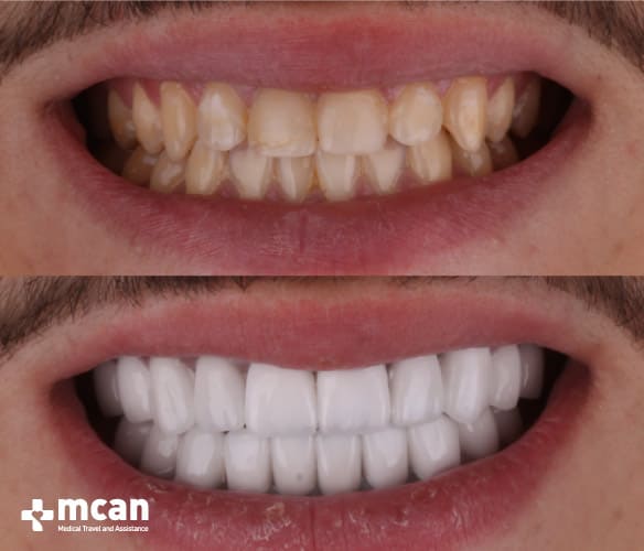 Antes y después de las coronas dentales 8