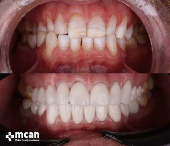 Antes y después de las coronas dentales 9