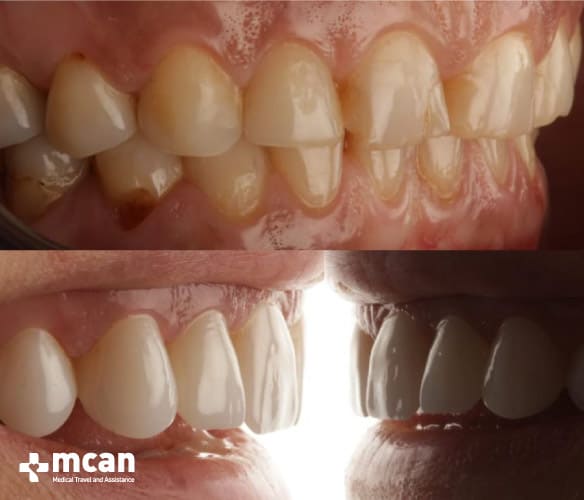 Whiter smile with dental crowns
