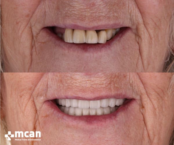 Dental implants Turkey results