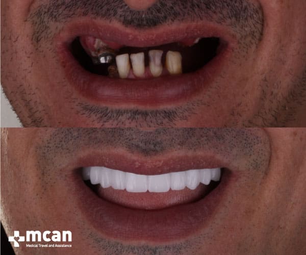 Dental implants turkey before and after