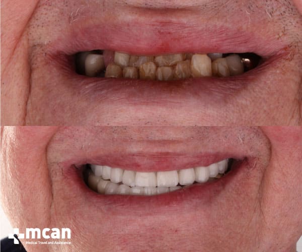 Best dental implants in Turkey before and after