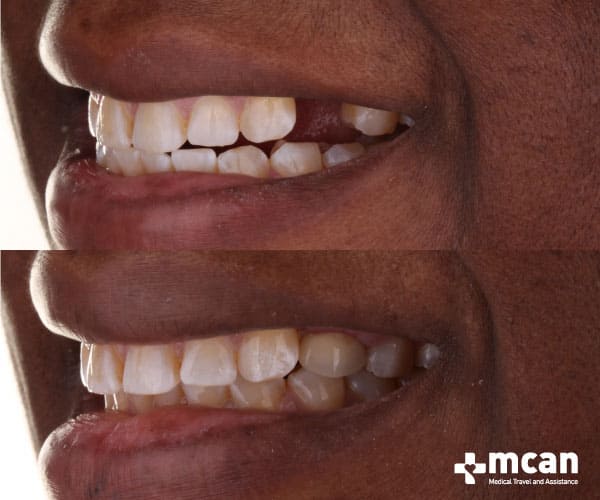 Full dental implants Turkey before and after