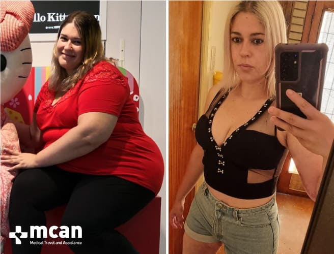 Antes y después de la cirugía bariátrica 2