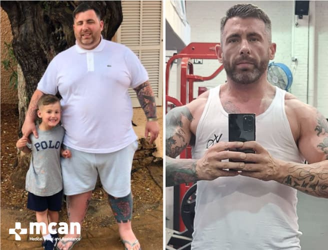 Antes y después de la cirugía bariátrica 1
