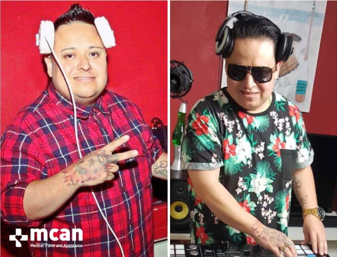 Antes y después de la cirugía bariátrica 11