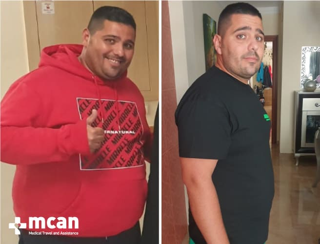Antes y después de la cirugía bariátrica 14