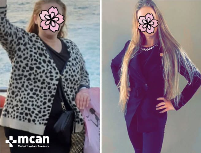 Antes y después de la cirugía bariátrica 16
