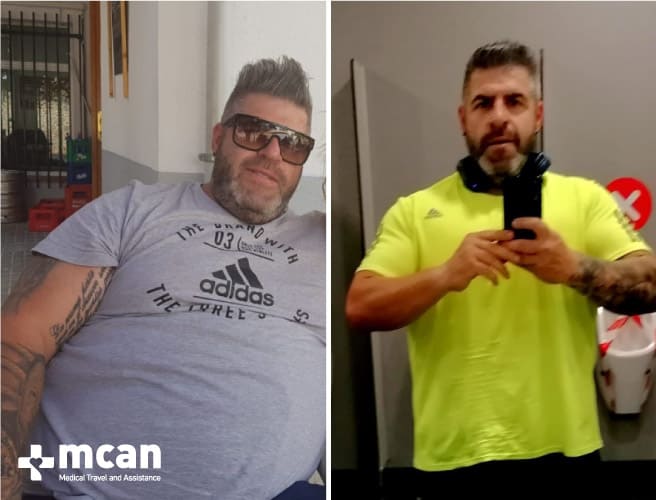 Antes y después de la cirugía bariátrica 17