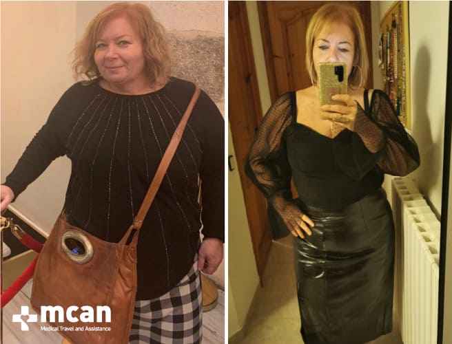 Antes y después de la cirugía bariátrica 18