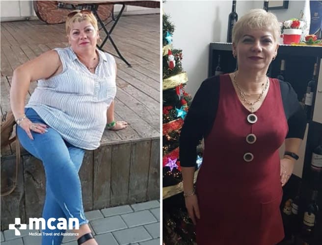 Antes y después de la cirugía bariátrica 19