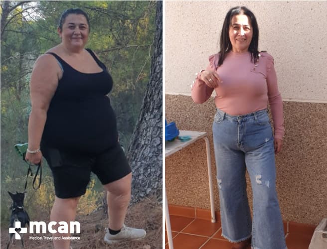 Antes y después de la cirugía bariátrica 6