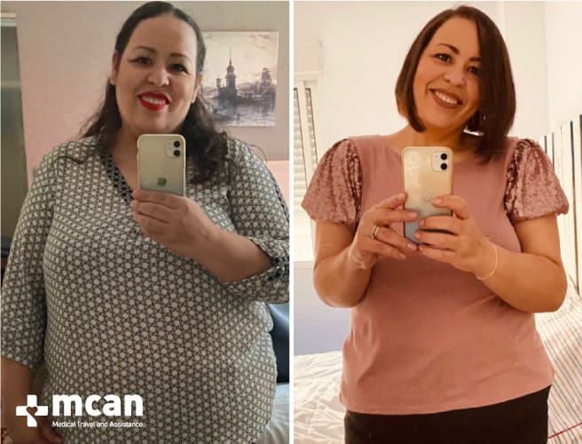 Antes y después de la cirugía bariátrica 8