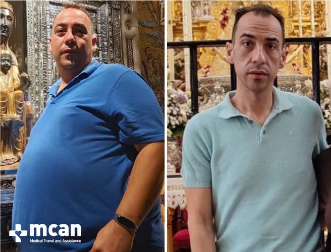 Antes y después de la cirugía bariátrica 9