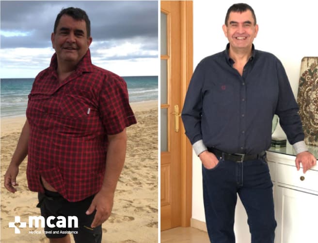 Antes y después de la cirugía bariátrica 10
