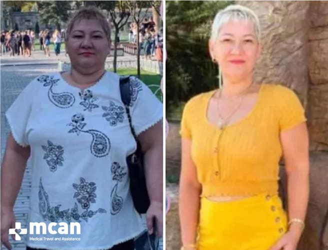 Antes y después de la cirugía bariátrica 12