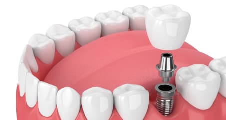 Enossale Implantate