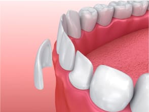 Wie werden Zahnveneers eingesetzt?