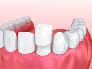 Paso a paso de las carillas dentales 4