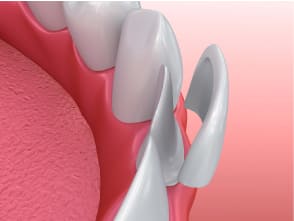 How are Dental Veneers Placed? 3