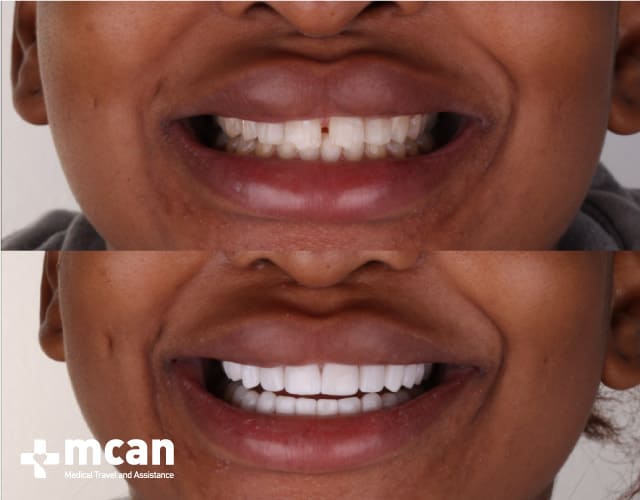 Antes y después de las Carillas de porcelana | MCAN Health