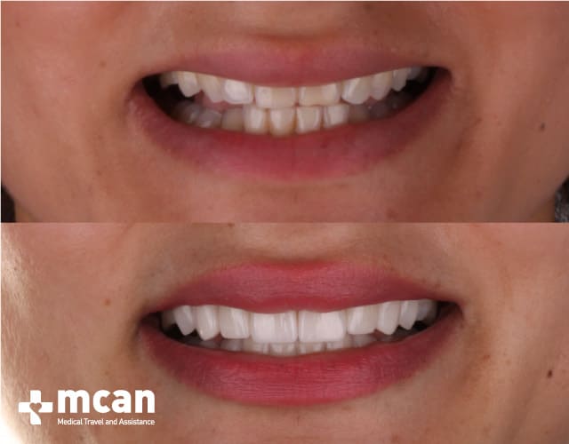Antes y después de las Carillas de porcelana 2 | MCAN Health