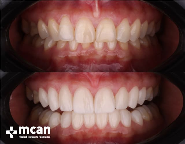 Antes y después de las Carillas de porcelana 3 | MCAN Health