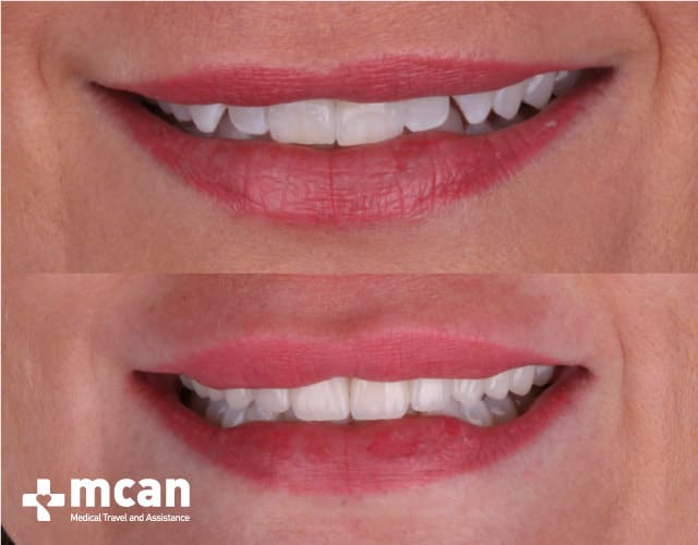 Antes y después de las Carillas de porcelana 4 | MCAN Health